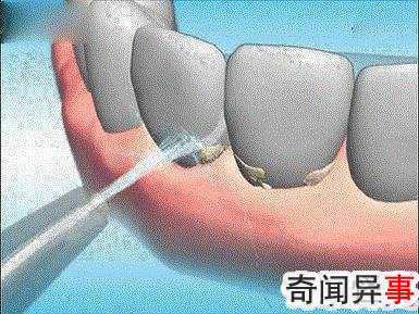 洗牙的好处和坏处